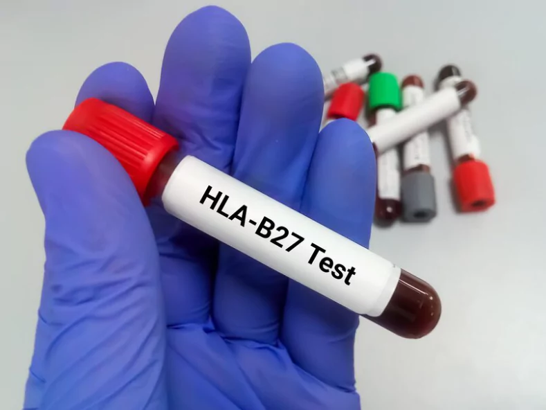 HLA B 27(EDTA BLOOD),(BY PCR)